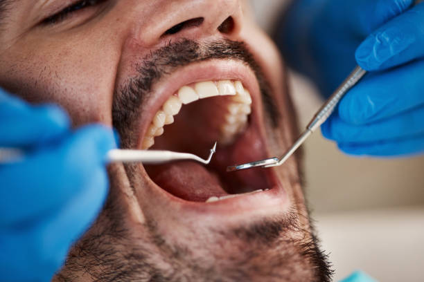 Best Emergency Wisdom Teeth Removal in Verona, KY